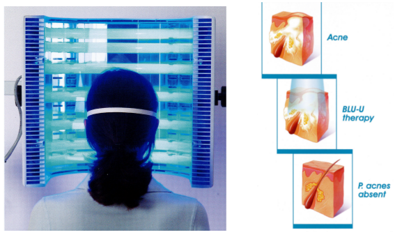 BLU-U Blue Photodynamic Therapy